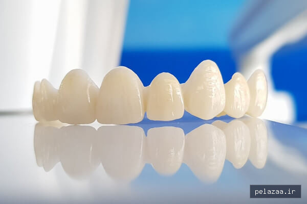 دندان مصنوعی ثابت چیست و چرا باید با آن - seramdental گرگان